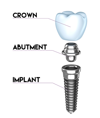 Dental Implant Illustration Dental Implant Illustration