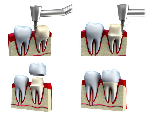 Dental Crown Installation Dental Crown Installation
