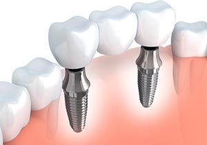 Implant Supported Bridge Implant Supported Bridge