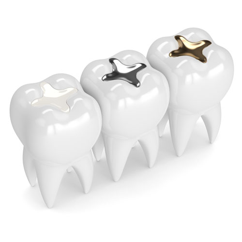 tooth colored fillings, metal illustration