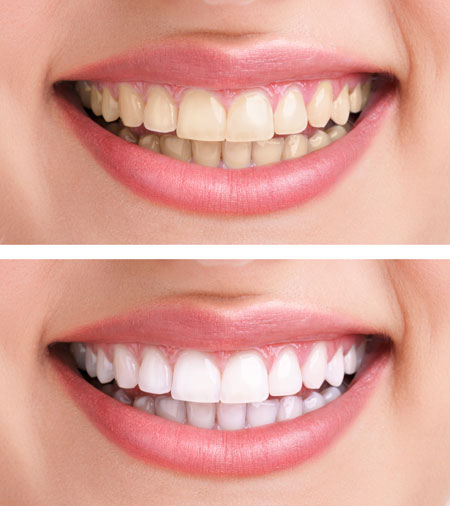 Teeth Whitening Before After Teeth Whitening Before After