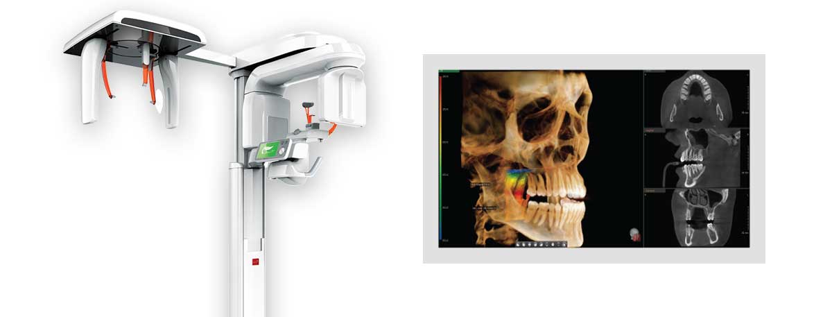 Green CBCT For Dental Implant Placement