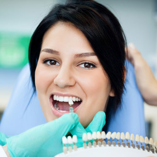 Dental Bonding Color Matching Dental Bonding Color Matching